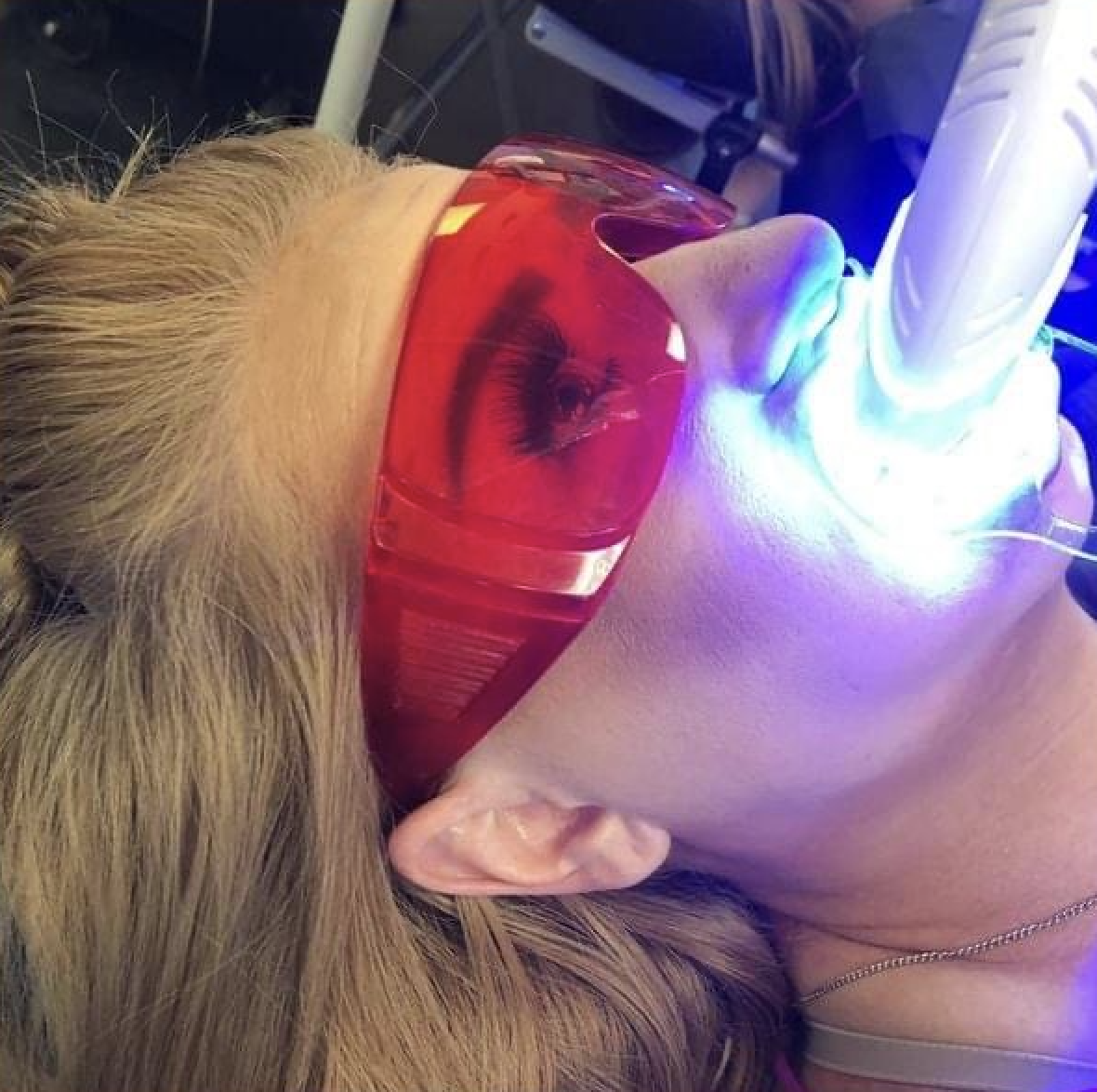 Teeth whitening treatment in progress at Facial Appeal