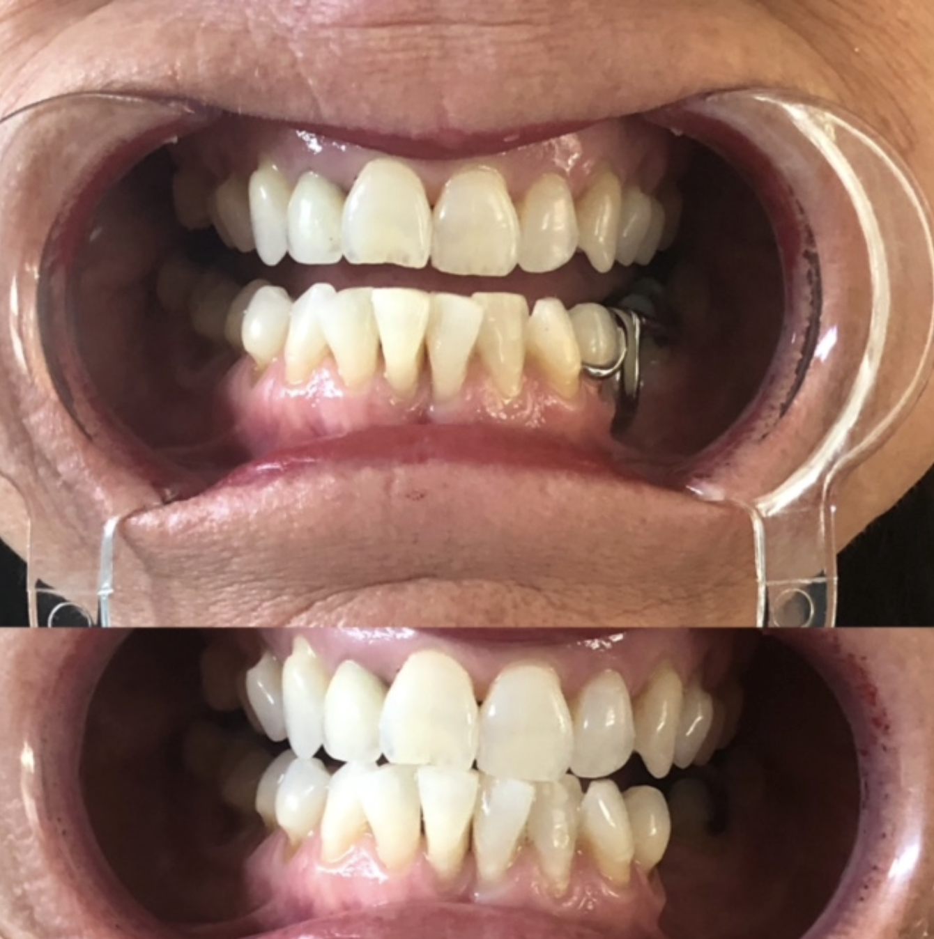 Before and after results from teeth whitening